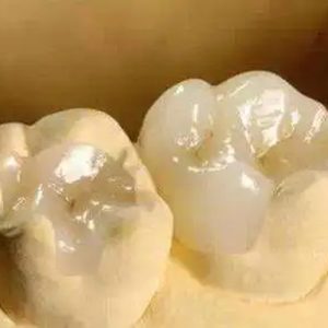 Zirconia Onlay