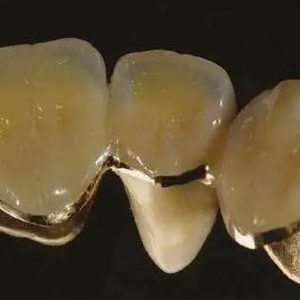 High Nobel yellow Gold PFM Crown