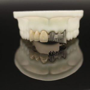 Porcelain Fused to Printed Metal Crown