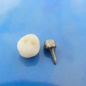 Separate Post &Core and PFM Crown