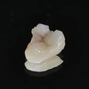 Zirconia Inlay
