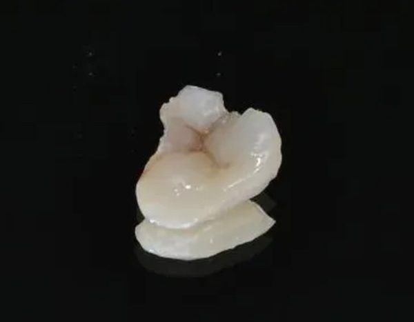 Zirconia Inlay